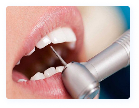 Bọc răng sứ không mài có được không?