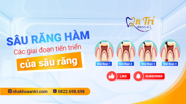 Đừng coi thường sâu răng hàm!