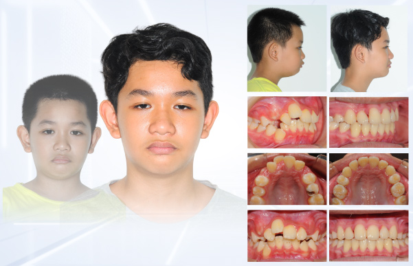 Hình: Hành trình thay đổi nụ cười 2