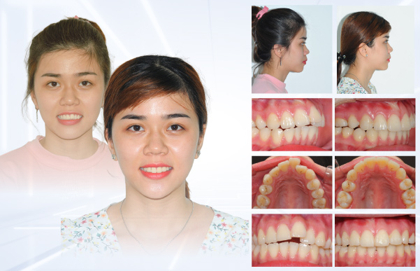 Hình: Hành trình thay đổi nụ cười 4