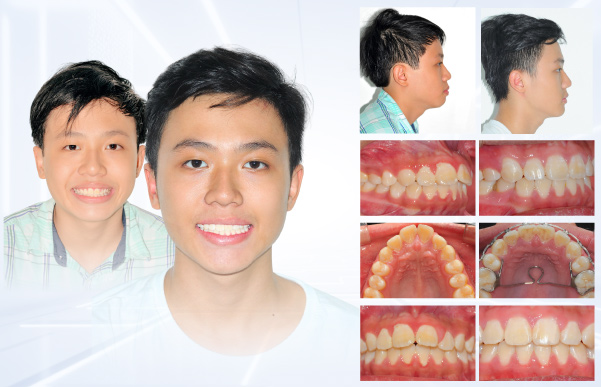 Hình: Hành trình thay đổi nụ cười 5