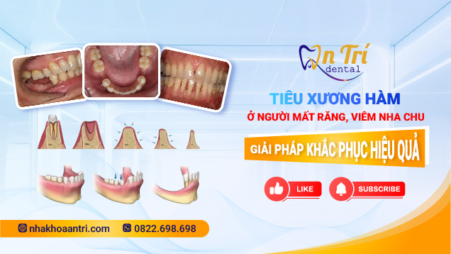 Tiêu xương hàm: Dấu hiệu, nguyên nhân và cách khắc phục