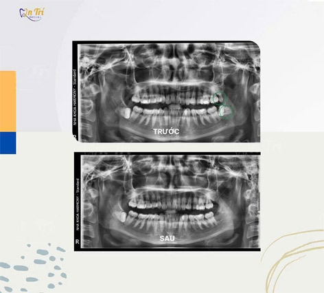 Hình 3:Khách hàng Nhổ răng khôn tại nha khoa An Trí