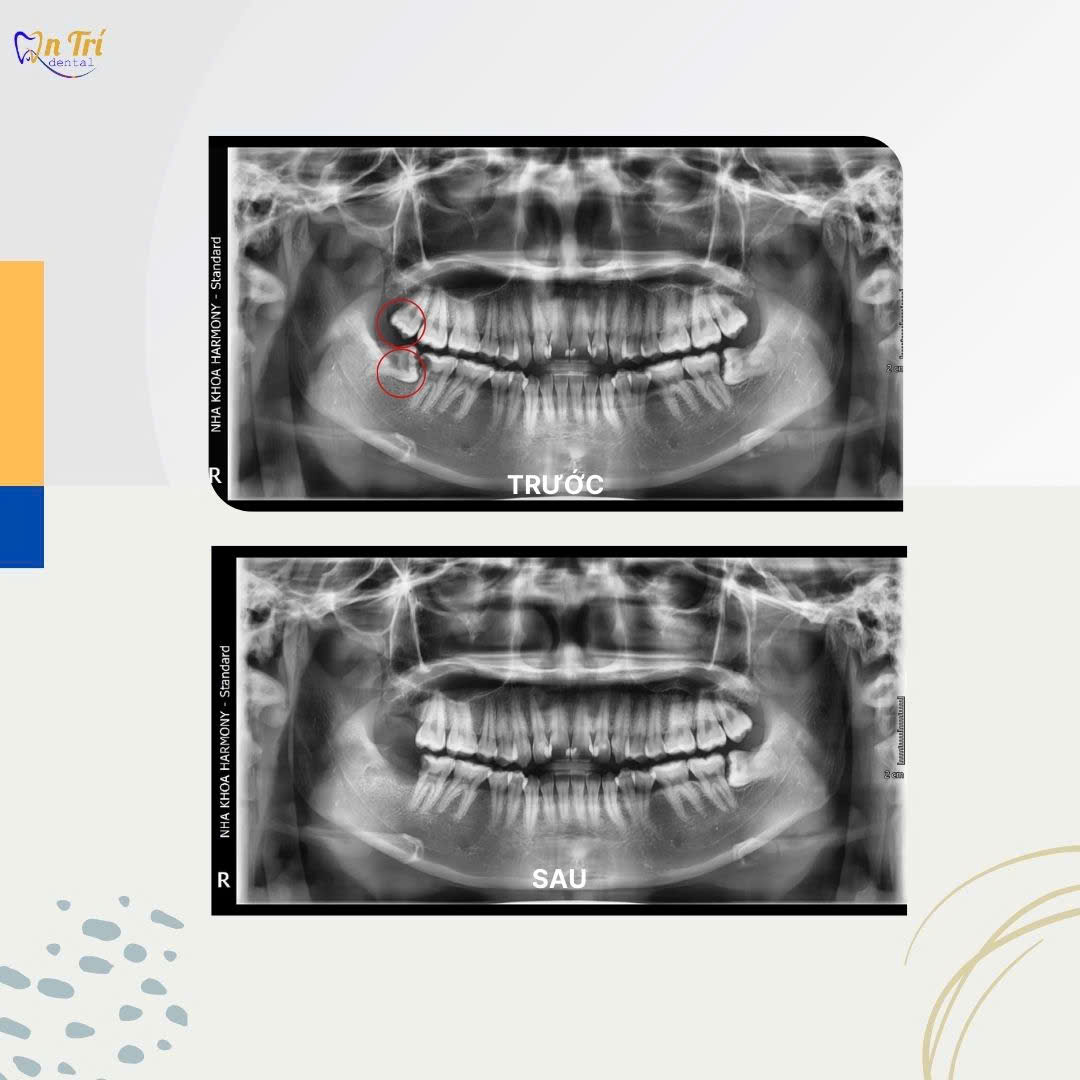 Hình 2: Khách hàng Nhổ răng khôn tại nha khoa An Trí