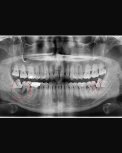 Là nguyên nhân tiềm ẩn của lệch khớp cắn và hôi miệng