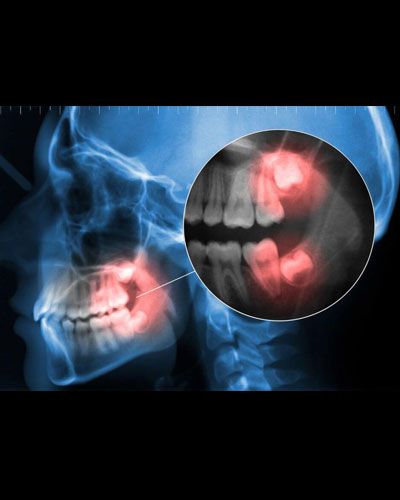 Làm tiêu xương hàm, viêm tủy, mất răng kế bên