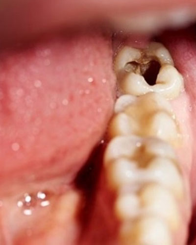 Nhét thức ăn – sâu răng kế bên