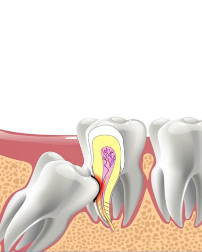 răng số 7 bị tấn công – lung lay, viêm tủy