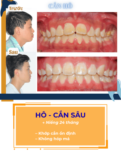 Hình Hô - Cắn sâu