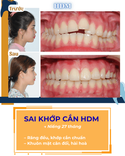 Hình sai khớp cắn HDM
