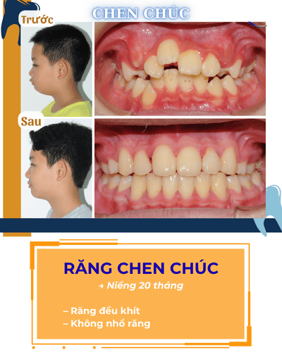 Hình răng chen chúc