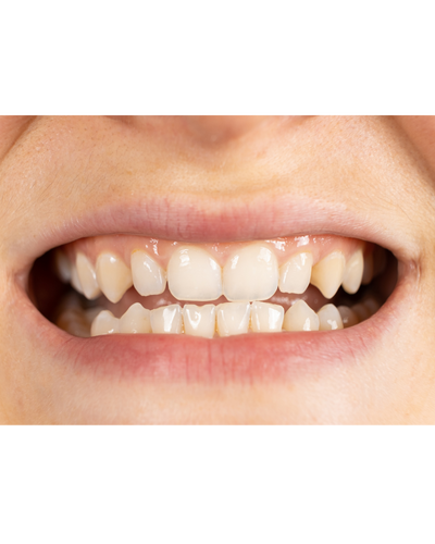 Lệch khớp cắn – khó nhai, đau quai hàm