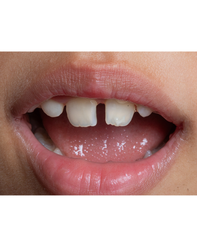 Răng thưa – cười hở kẽ, thiếu thẩm mỹ