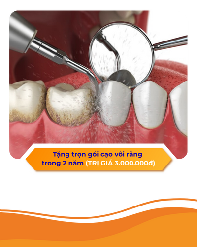 Nhét thức ăn – sâu răng kế bên