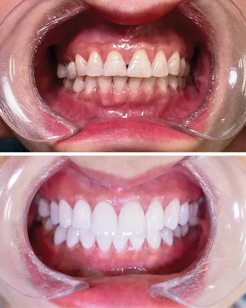 Bọc 16 răng sứ Cercon Đức