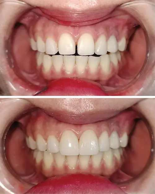 Bọc sứ Zirconia 2 răng cửa