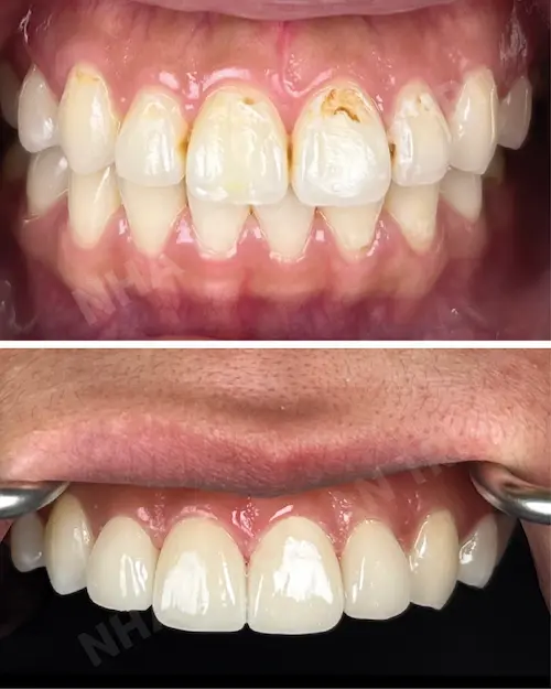 Dán sứ Veneer Emax CAD/CAM 6 răng
