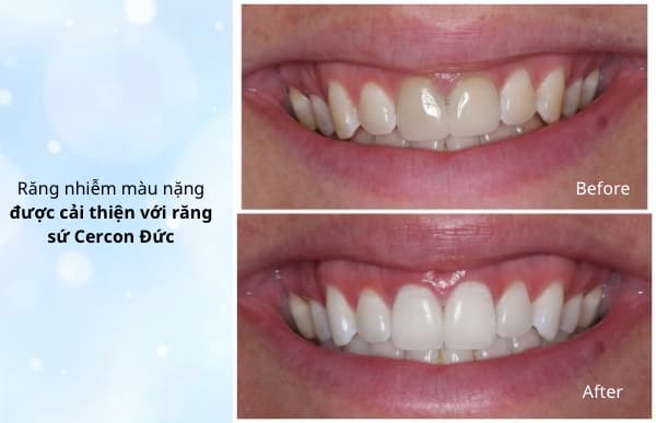Hình: Hành trình thay đổi nụ cười 1