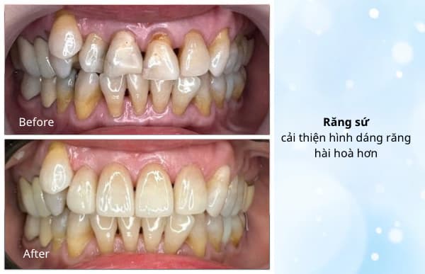 Hình: Hành trình thay đổi nụ cười 4