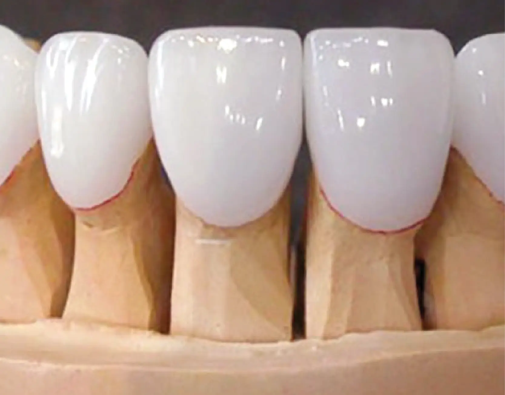 Răng sứ cercon (Đức)