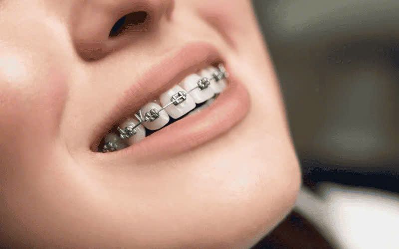 Chính sách bảo hành niềng răng tại An Trí sẽ đảm bảo quyền lợi tối ưu cho khách hàng