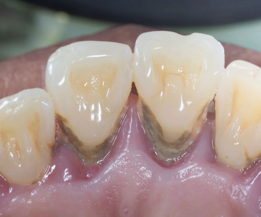 e-buot-rang-phai-lam-sao-3