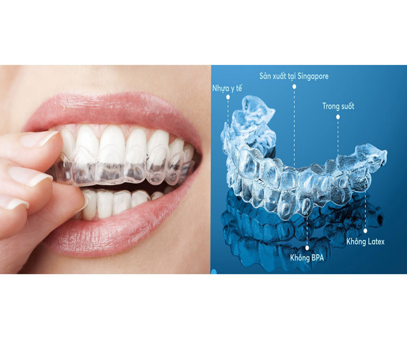 Niềng răng khay trong suốt Invisalign